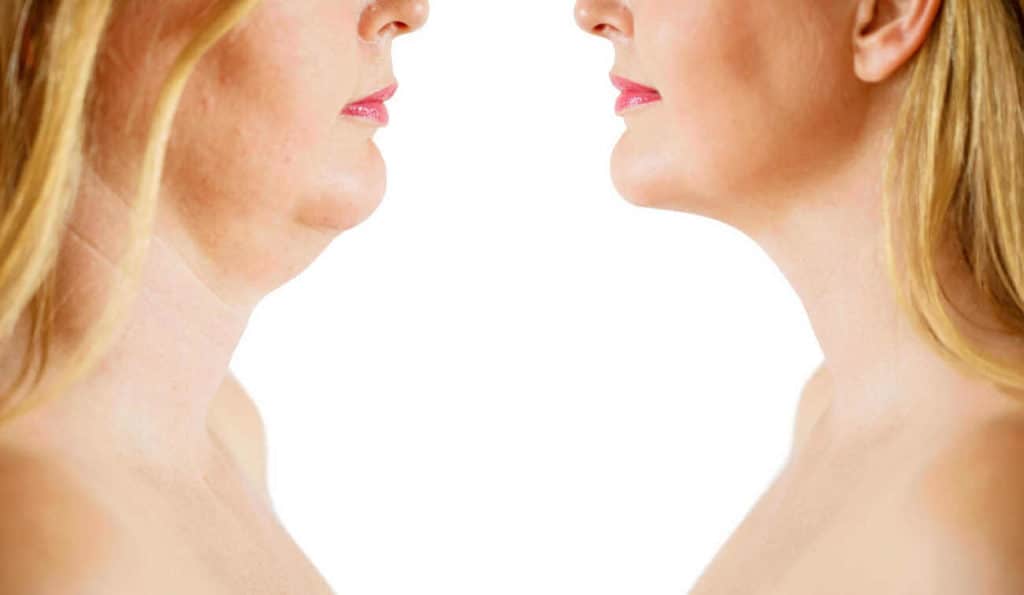 Double Chin treatment Willesden before and after results