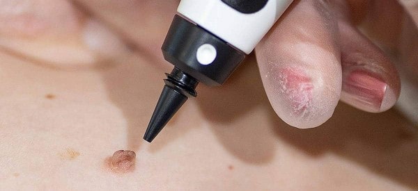 After Skin Tag Removal Willesden