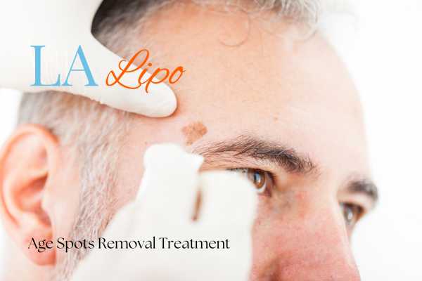What Are the Most Effective Treatments for Age Spots Willesden?