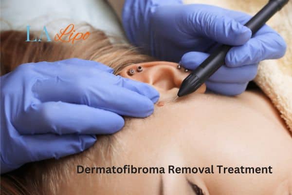 Dermatofibroma Removal Treatment Willesden