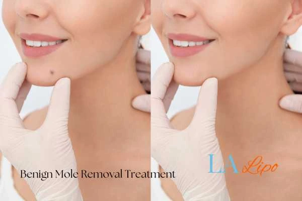 woman's before and after mole removal Willesden results