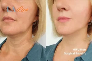 hi-fu for wrinkles Willesden before and after results