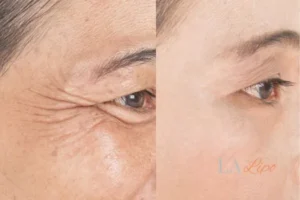Before and after results of woman - HI-fu wrinkles reduction treatment Willesden