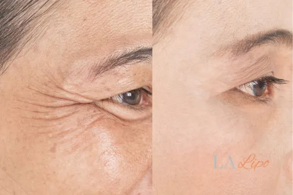 Before and after results of woman - HI-fu wrinkles reduction treatment Willesden