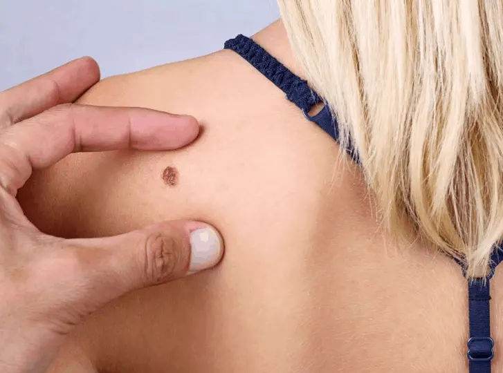 woman having mole removal Willesden consultation before treatment.