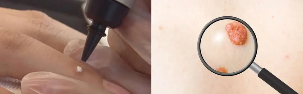 Cryopen for mole removal Willesden - speak to our team today!