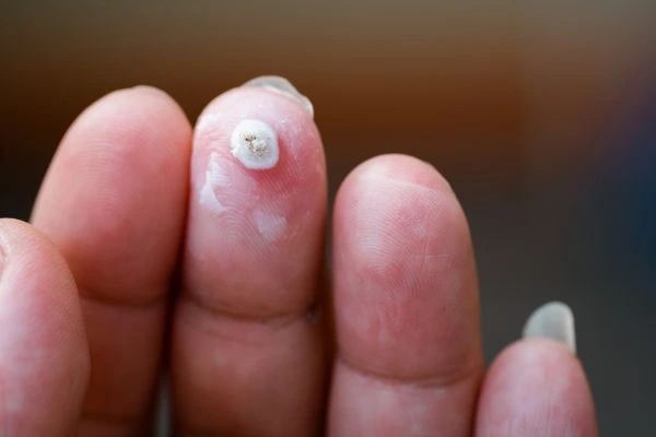 wart on person finger - cryotherapy to treat from LA LIPO Willesden