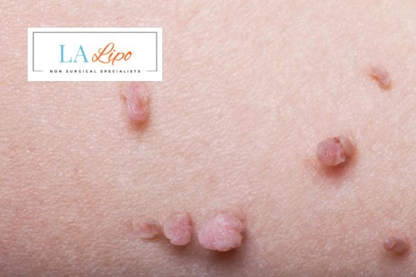 Does cryopen skin tag removal Willesden hurt? Find out now call our team today!