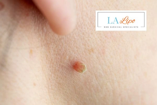 Book skin tag removal Willesden today speak to our team now!