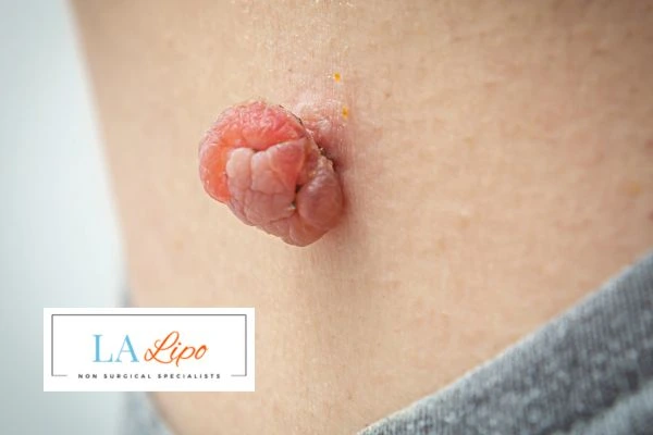 Interested in skin tag removal Willesden? Concerned about the pain? Find out more today!