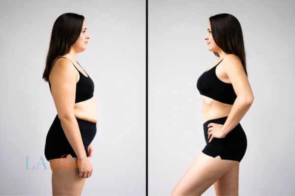 Picture of womans before and after using LA-EMS body sculpting to improve her core strength Willesden