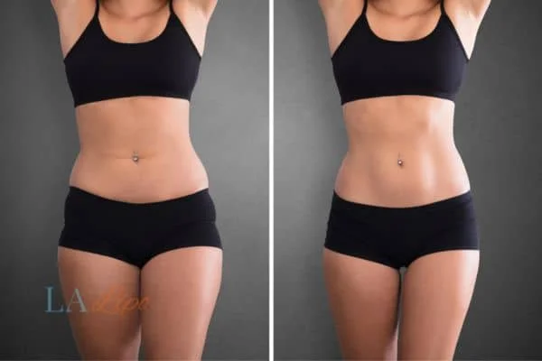 before and after results of non-surgical treatment to help a woman's body image and mental health Willesden