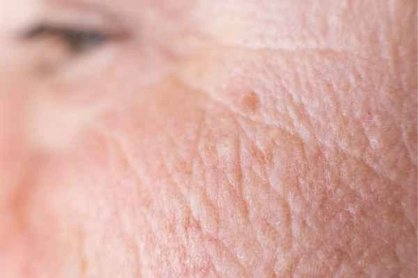 close up picture of a woman's face showing an age spot Willesden