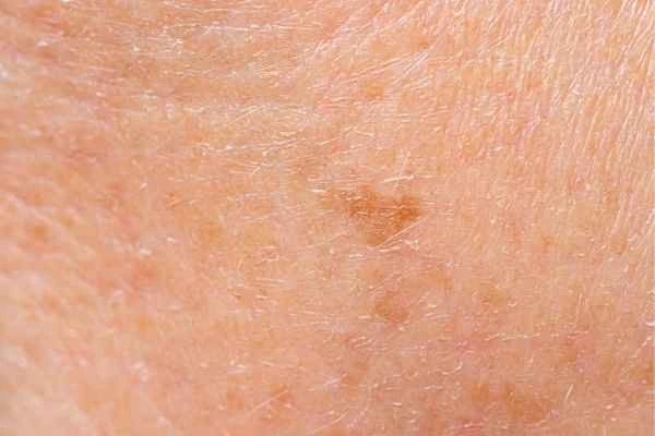close up picture of age spots Willesden
