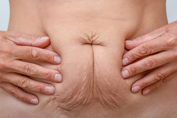 Image of a woman's stomach with loose skin - example of skin tightening Willesden options