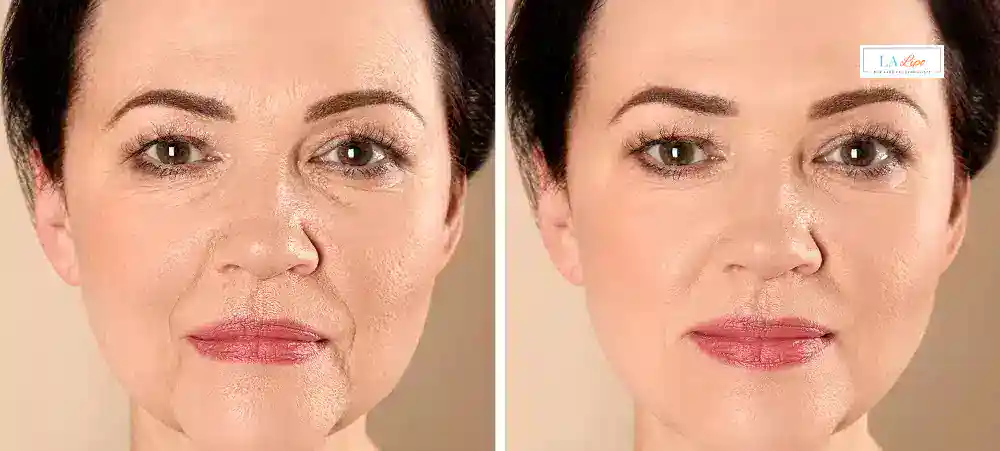 How Long Does It Take to See Results and How Long Do They Last Willesden?